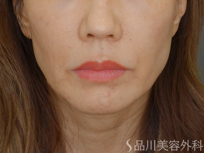 症例NO.71800のBEFORE写真