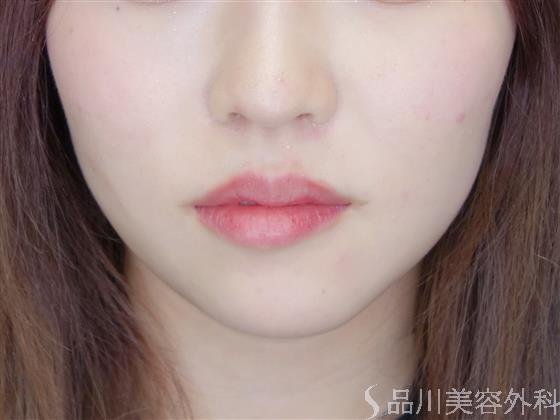 症例NO.51310のBEFORE写真