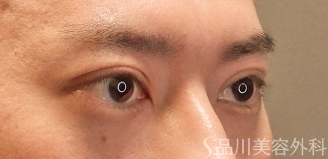 症例NO.72590のAFTER写真