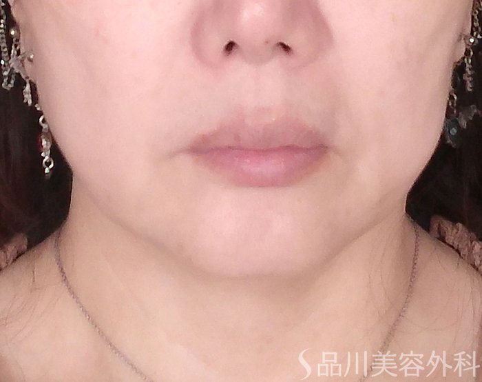 症例NO.70459のBEFORE写真