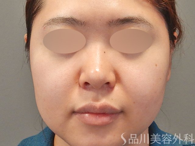 症例NO.75108のAFTER写真