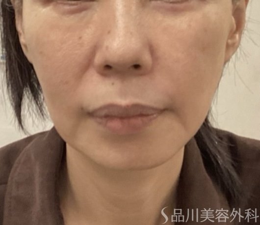 症例NO.75362のBEFORE写真