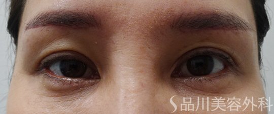 症例NO.74744のAFTER写真