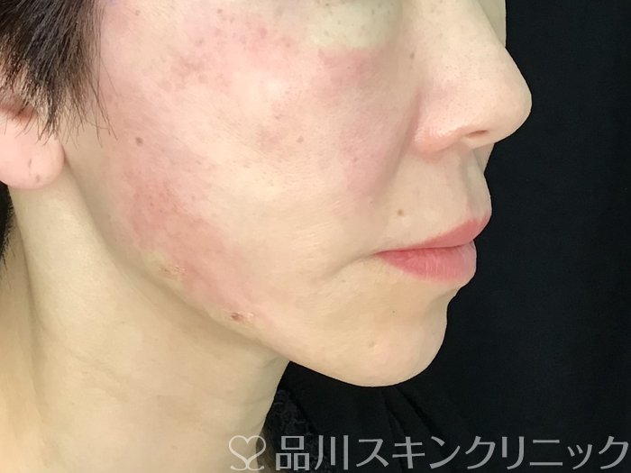 症例NO.71411のAFTER写真