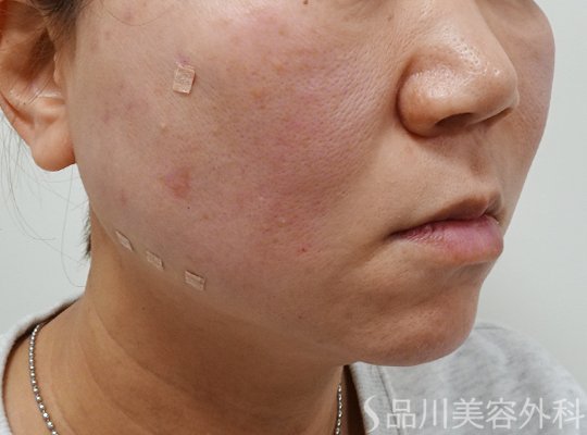 症例NO.73437のAFTER写真