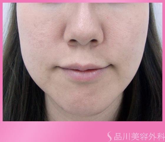 症例NO.1164のBEFORE写真