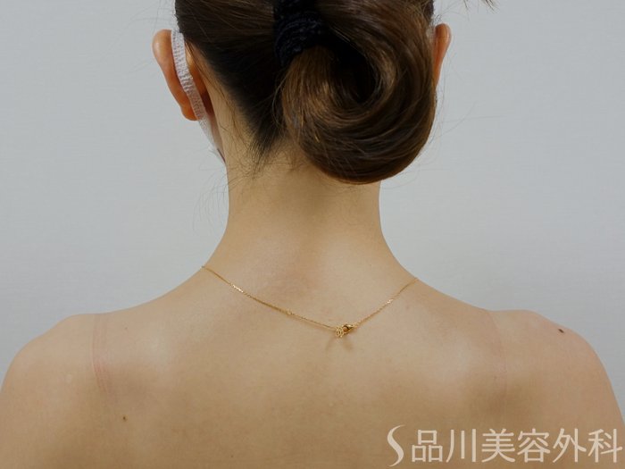 症例NO.73298のAFTER写真