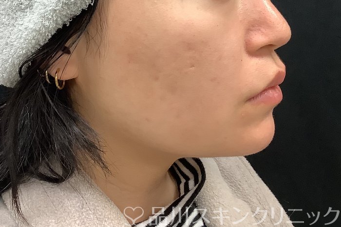 症例NO.69513のAFTER写真