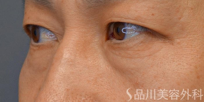 症例NO.71953のBEFORE写真