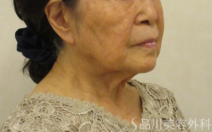 症例NO.72613のBEFORE写真