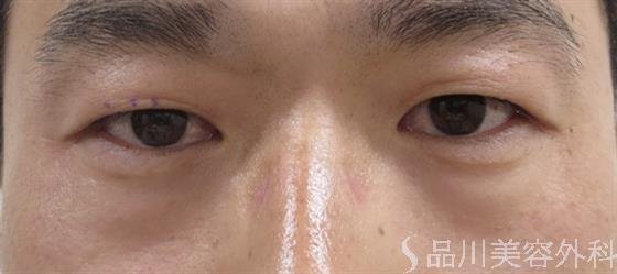 症例NO.35523のBEFORE写真