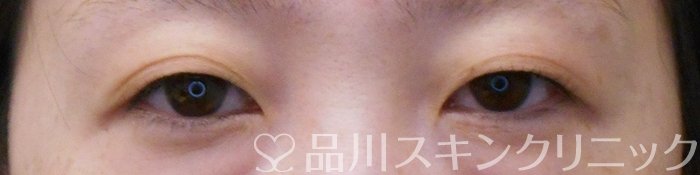 症例NO.74517のBEFORE写真