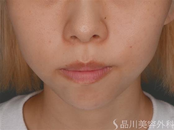 症例NO.52575のAFTER写真