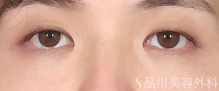 症例NO.72308のBEFORE写真