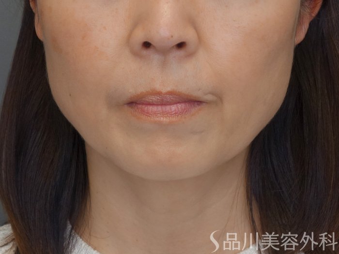 症例NO.72558のBEFORE写真