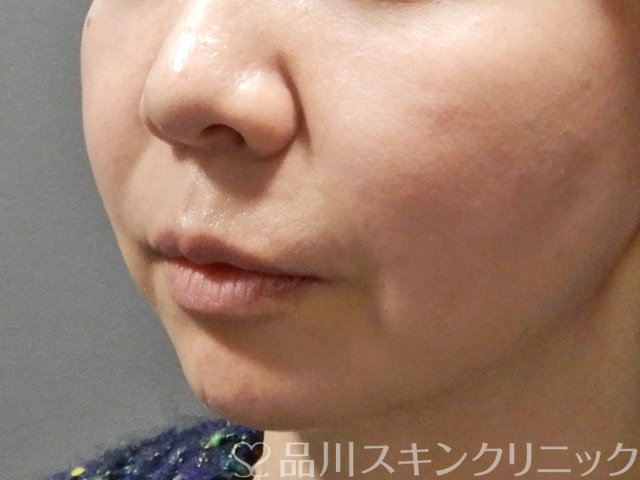 症例NO.63368のBEFORE写真