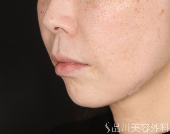 症例NO.73411のAFTER写真