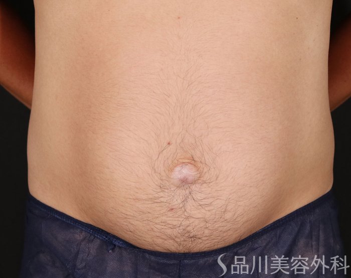 症例NO.71756のBEFORE写真