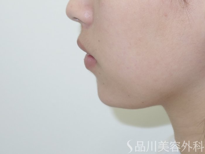 症例NO.69528のAFTER写真