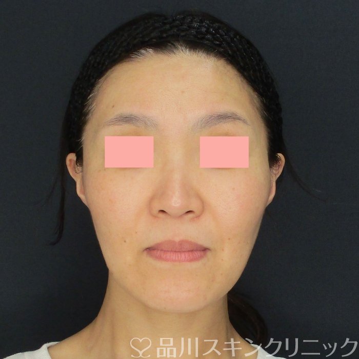 症例NO.72450のAFTER写真