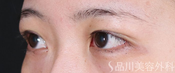 症例NO.71075のAFTER写真
