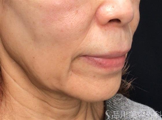 症例NO.59174のBEFORE写真