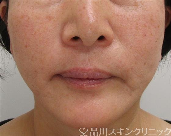 症例NO.41090のAFTER写真