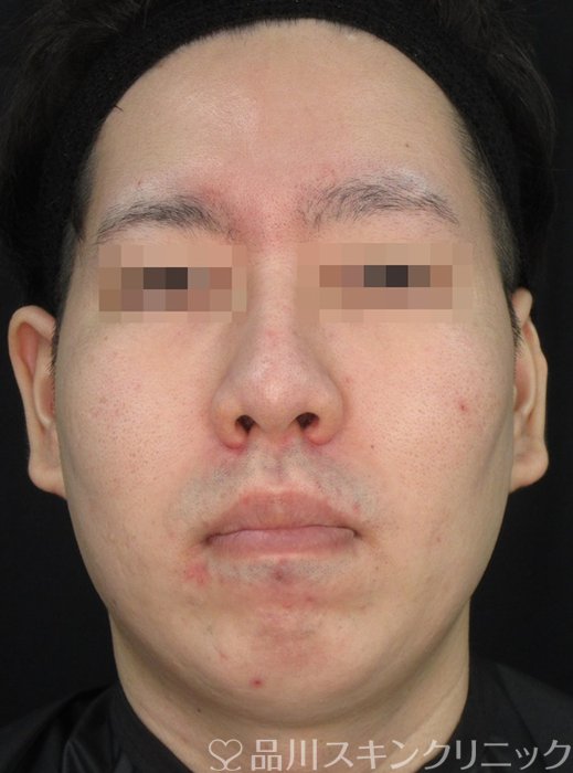 症例NO.72307のBEFORE写真