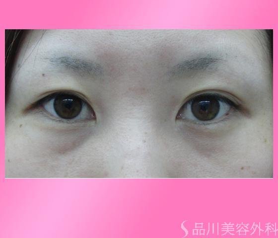 症例NO.14825のBEFORE写真