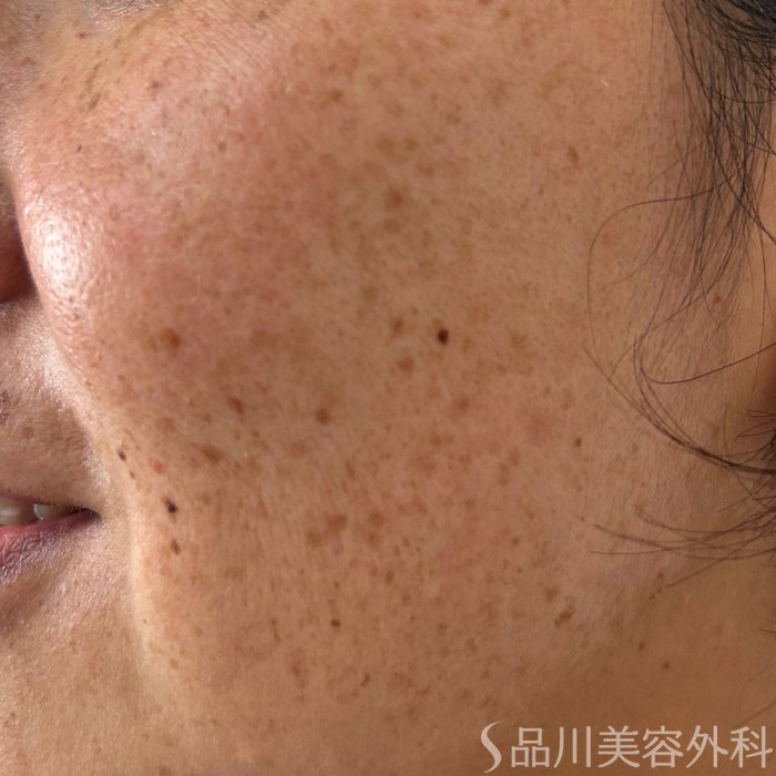 症例NO.68227のBEFORE写真