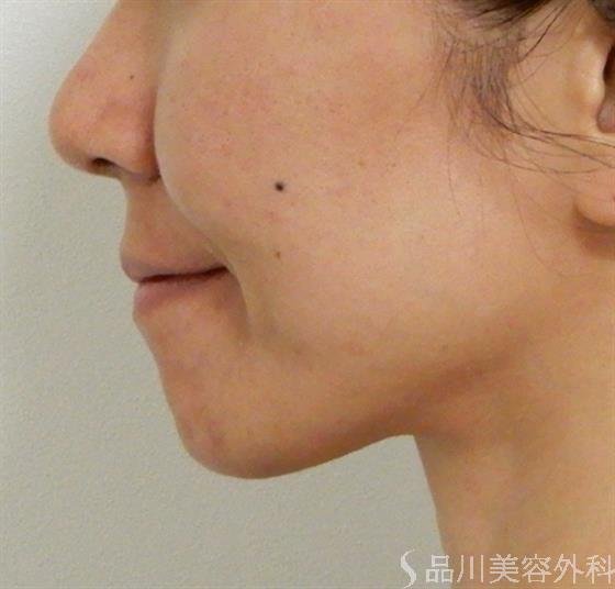 症例NO.39106のBEFORE写真