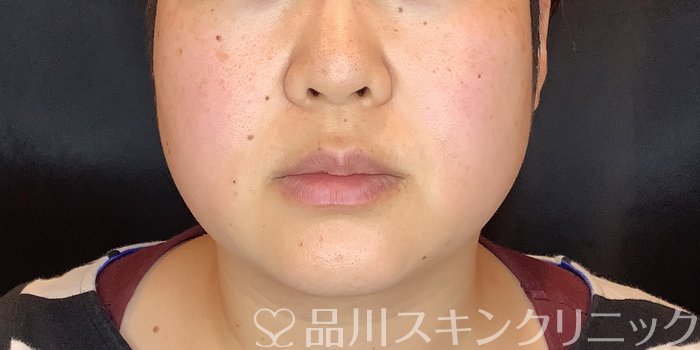 症例NO.70081のBEFORE写真