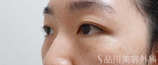 症例NO.69882のBEFORE写真