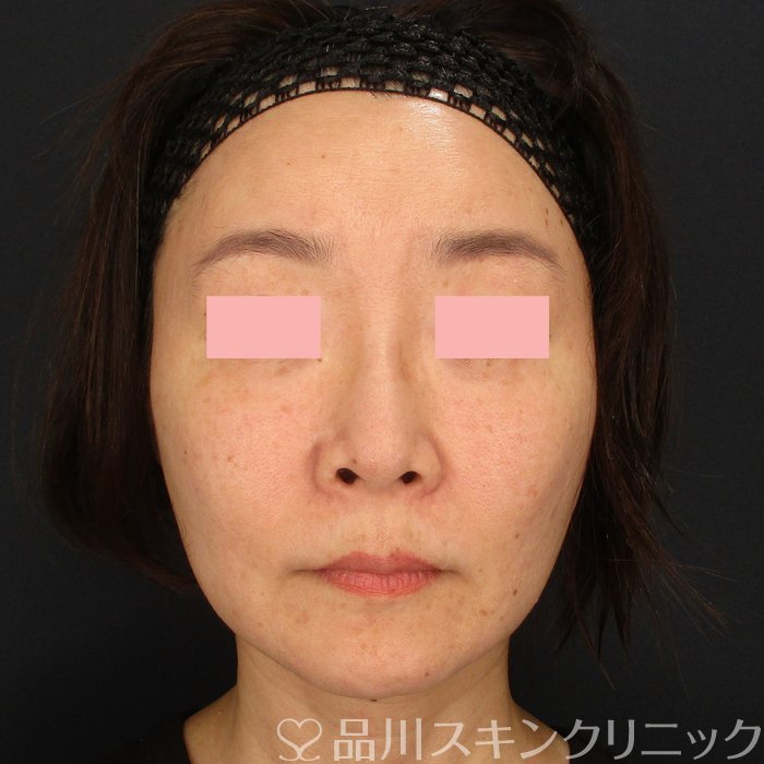 症例NO.71742のBEFORE写真