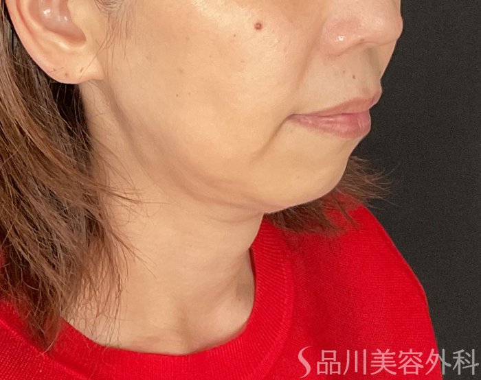 症例NO.74685のBEFORE写真