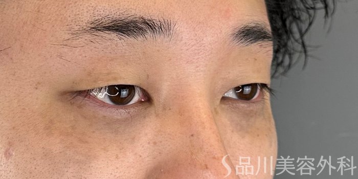 症例NO.72839のBEFORE写真