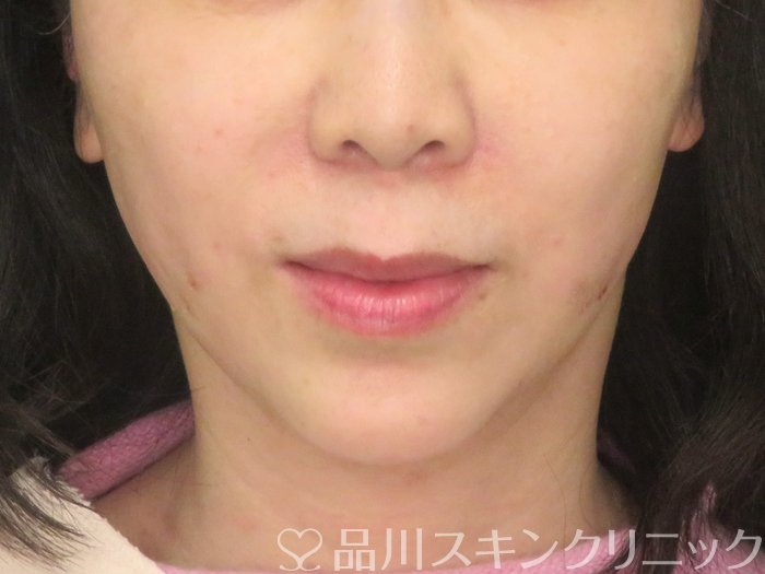 症例NO.67637のAFTER写真