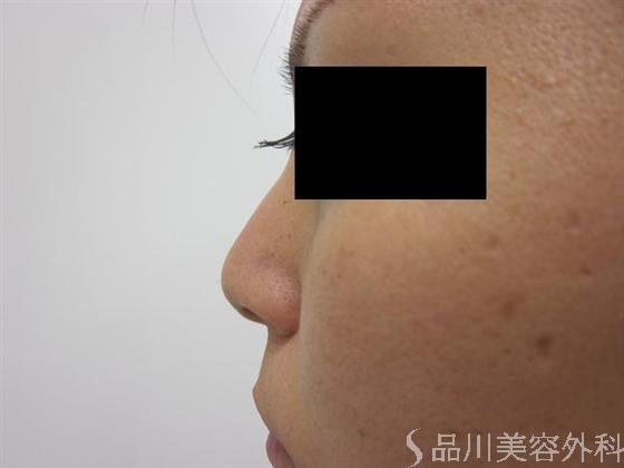 症例NO.10099のBEFORE写真