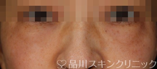 症例NO.63903のBEFORE写真