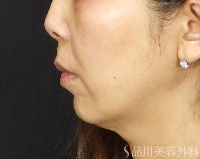症例NO.71501のBEFORE写真
