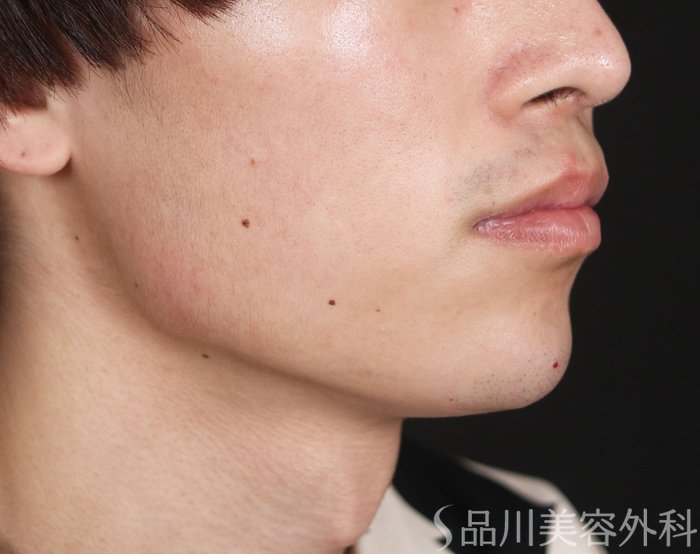 症例NO.73766のAFTER写真