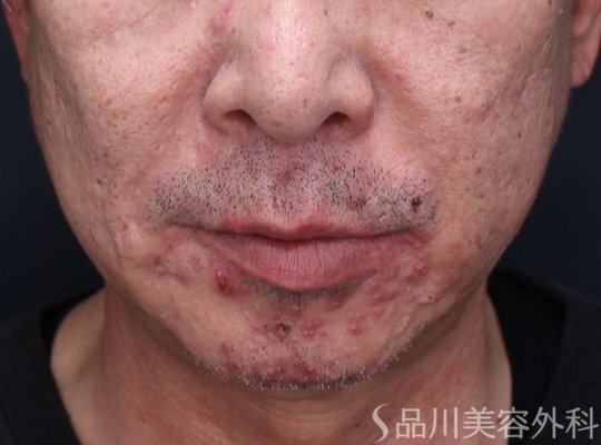 症例NO.72129のBEFORE写真