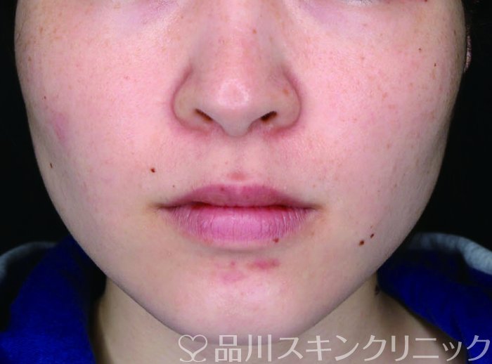 症例NO.72951のBEFORE写真