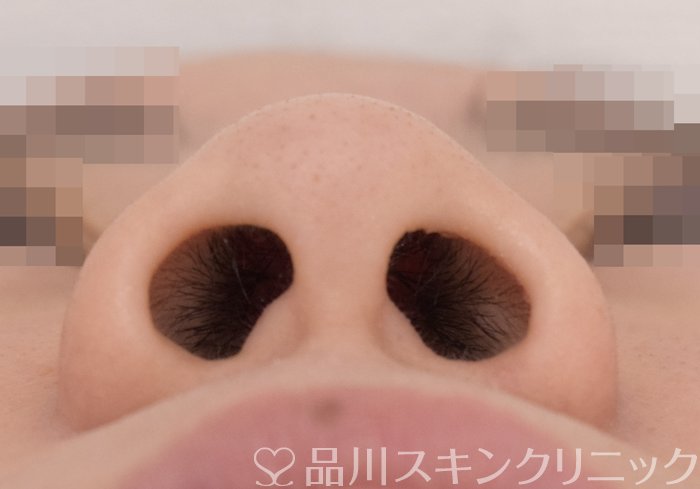 症例NO.71736のBEFORE写真
