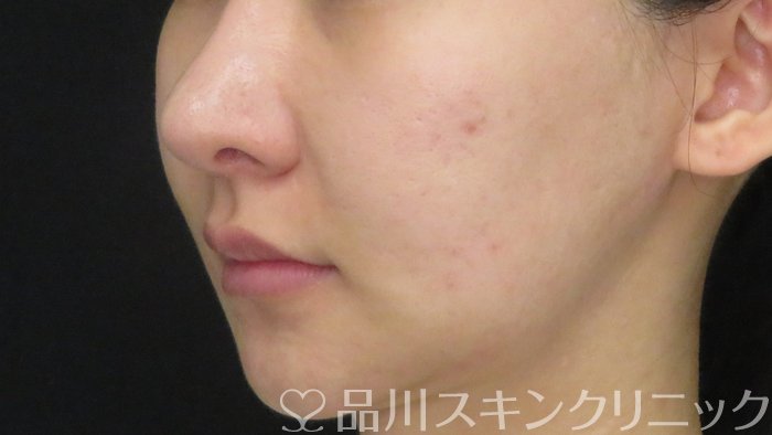 症例NO.71930のBEFORE写真