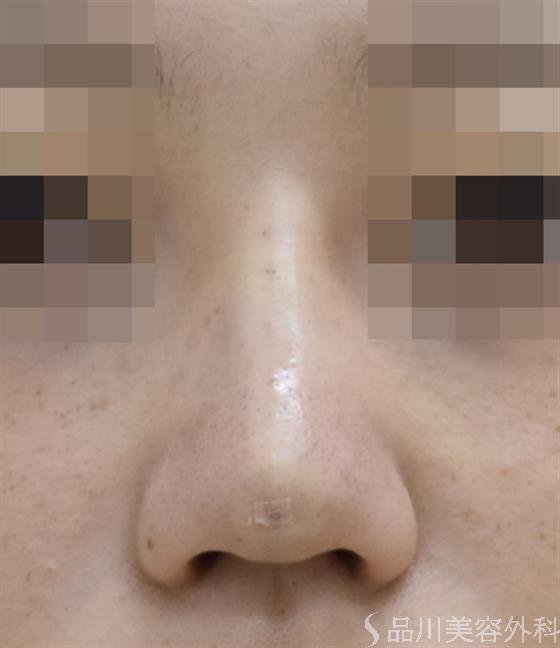 症例NO.44115のAFTER写真