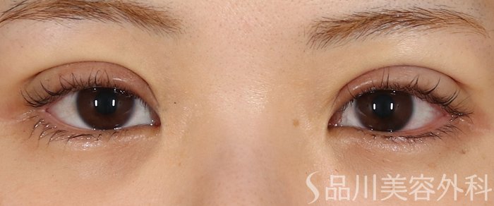 症例NO.72334のAFTER写真