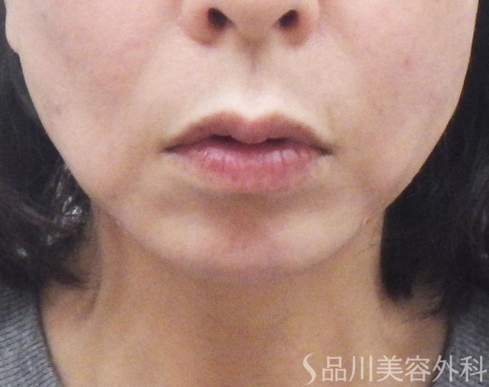 症例NO.72818のAFTER写真