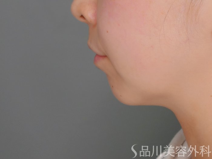 症例NO.69870のBEFORE写真