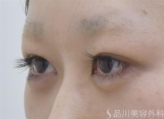 症例NO.52692のBEFORE写真